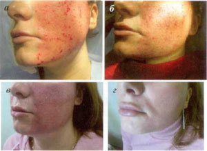 Stages of skin regeneration after fraction ablation procedure