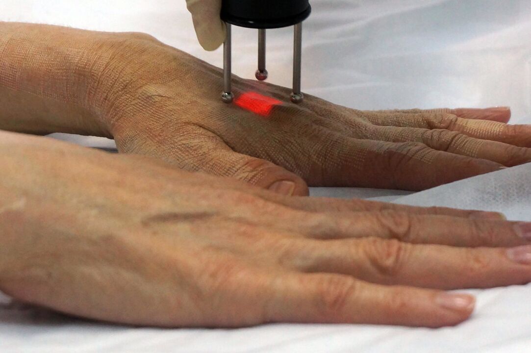 Laser hand rejuvenation by non-ablative method
