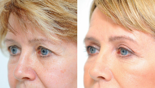 blepharoplasty-before and after
