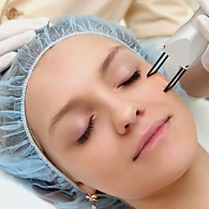 Laser fraction rejuvenation